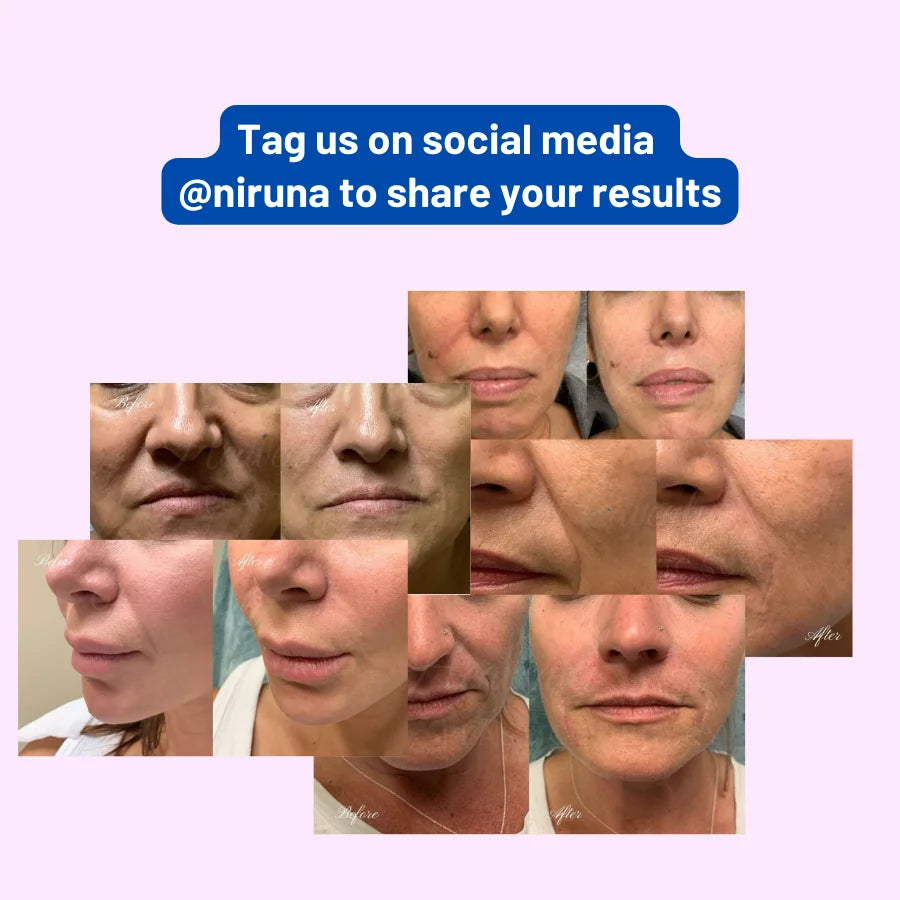 Niruna Forehead Lines Lifting Mask (10 pack)